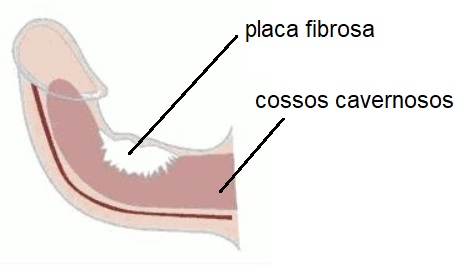 penis corbat peyronie