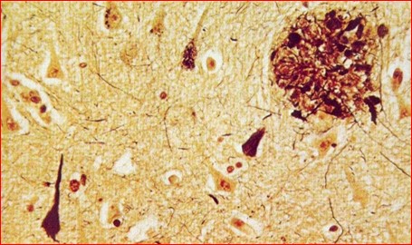 Teixit cerebral amiloide pobresa neuronal