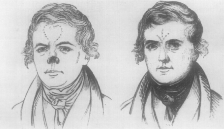 Cirurgia plàstica Liston