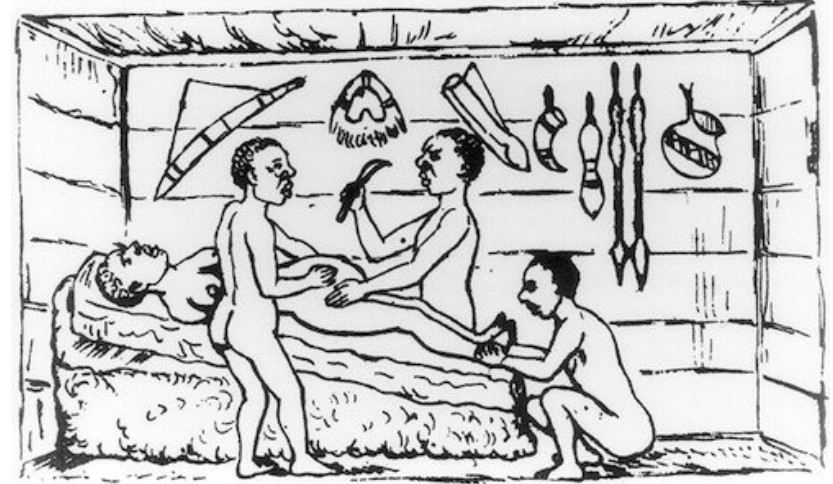 Cesària indígena a Kahura, Uganda. 