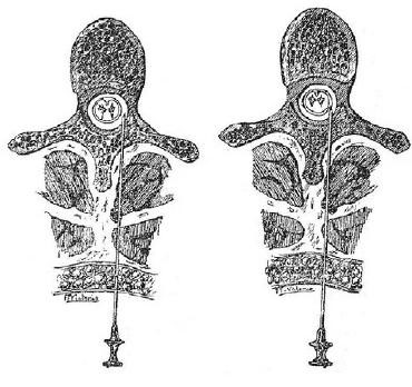 Pagés punció anestèsia epidural