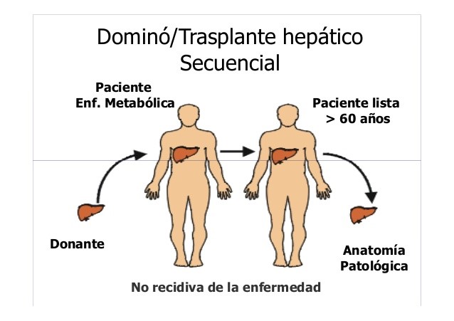 Trasplantament hepàtic secuencial