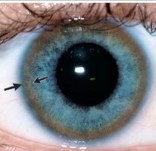 Anell de Kayser - Fleischer