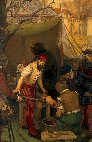 Ambroise Paré utilitzant la lligadura a Damvilliers, per Ernest Board