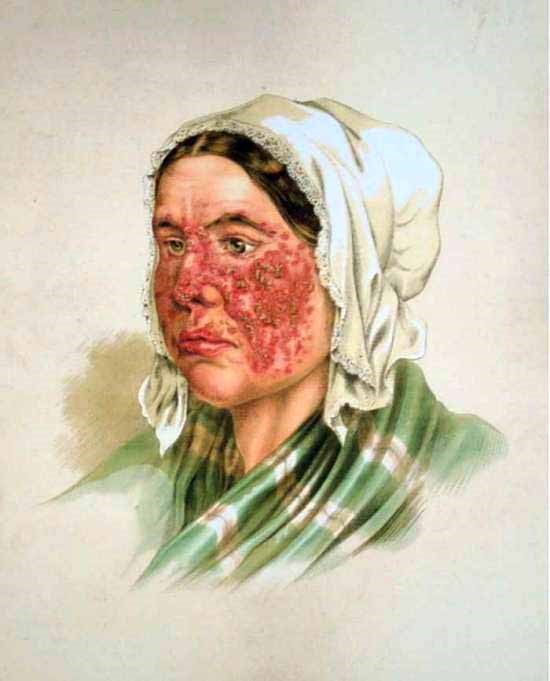 Lupus eritematós, il·lustració de l'Atlas de Dermatologia