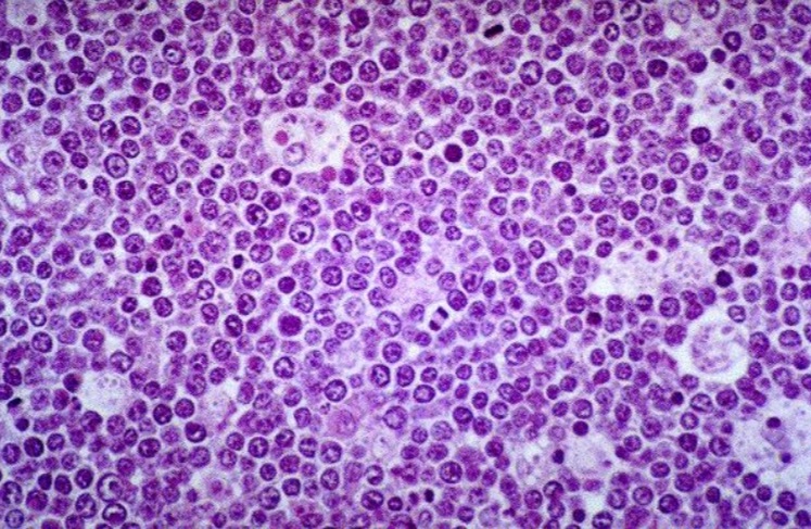 Proliferació de cèl·lules monomorfes, de mida mitjana,  i citoplasma basòfil, en un gangli submaxilar 