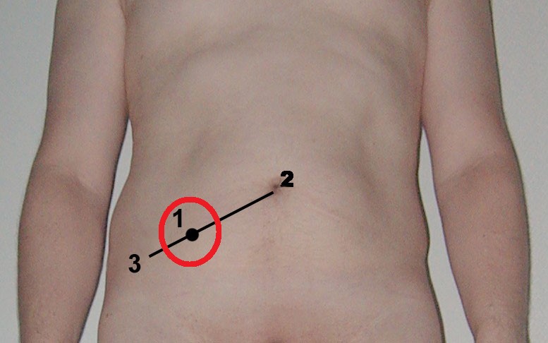 Punt de McBurney (1), entre el melic (2) i l'espina ilíaca superior (3)
