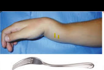 Fractura de Colles. Aspecte de "dors de forquilla"