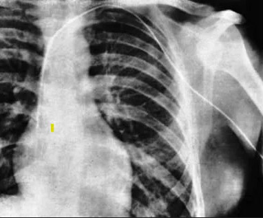 Demostració radiològica de la presència de l'extrem del catèter al cor.