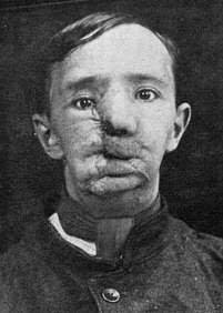 Cara destruïda d'un soldat francès