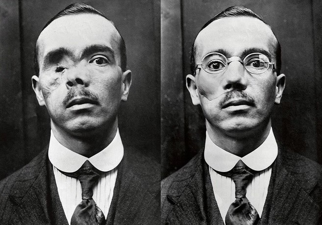 Reconstrucció facial pel Dr. Morestin