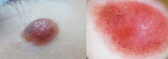 Nevus de Spitz. Lesió sobreelevada, cupuliforme, de vores regulars, eritematosa. 
A la dermoscòpia (dreta), es veu un patró vascular de vasos puntiformes.