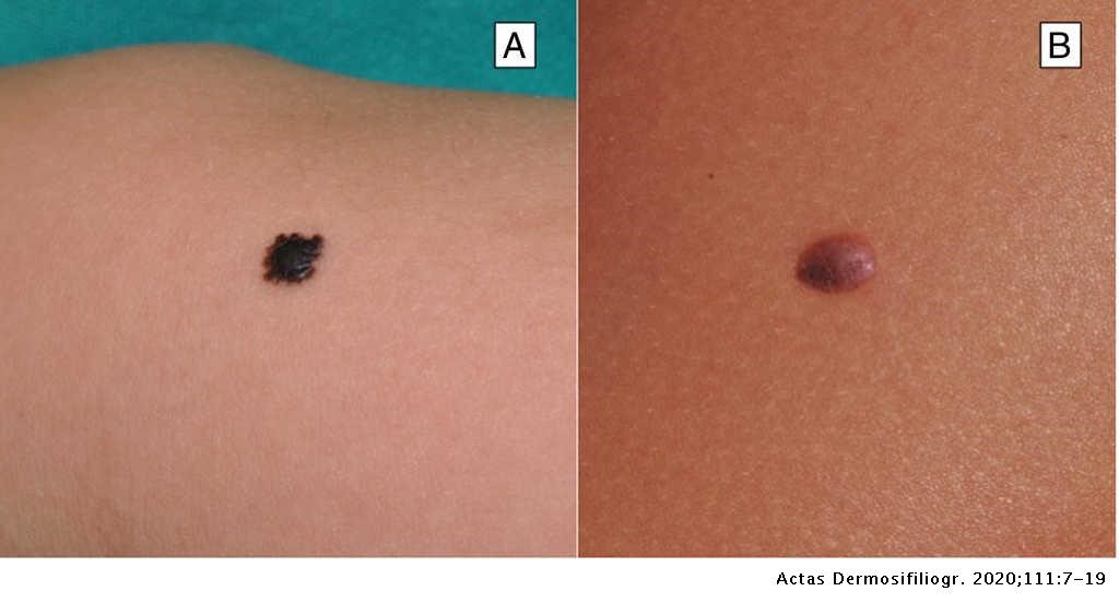 Dos exemples de nevus de Spitz