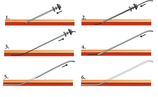 Tècnica de Seldinger pas a pas