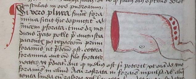 Orificis de fístules anals