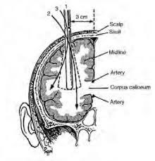 En fer rotar des de l'exterior l'agulla introduïda dins el crani, la nansa de filferro secciona totes les fibres que arriben o surten de l'escorça cerebral frontal