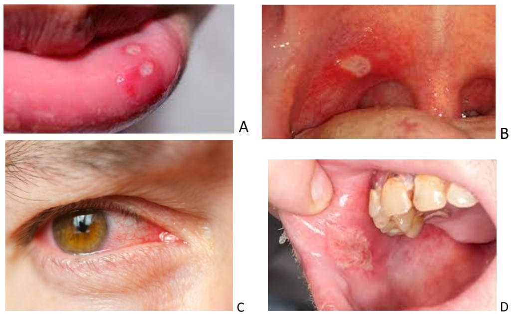 Lesions de la malaltia de Behçet. A. Úlcera al penis, B. Úlcera faríngea, C. Iritis, D. Úlcera a la mucosa bucal