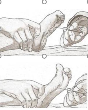 Reflex plantar normal en la part superior i reflex de Babinski (amb extensió del dit gros) en la part inferior.