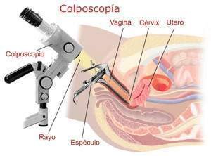 La colposcopia permet l'examen de la cavitat vaginal i del coll de l'úter