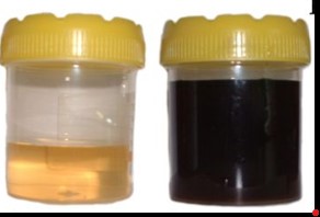 Orina de un pacient amb alcaptonúria (a la dreta)