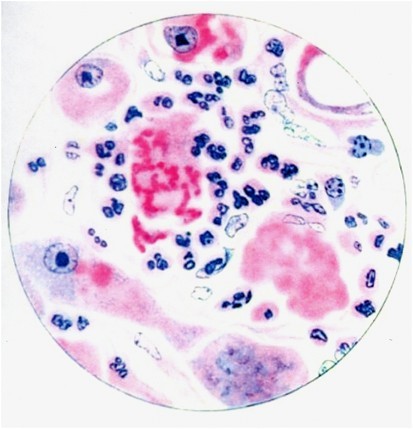 Imatge de la hialina alcohòlica del llibre de FB Mallory’s "Principles of Pathologic Histology" (Elsevier 1914).