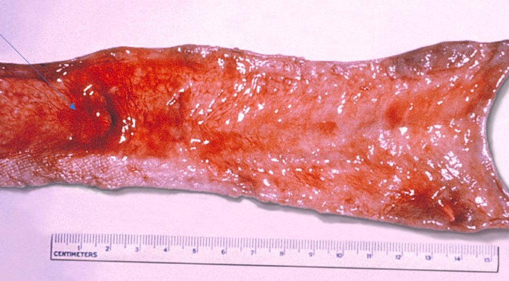 Ulceració intestinal per febre tifoide (fletxa esquerra)