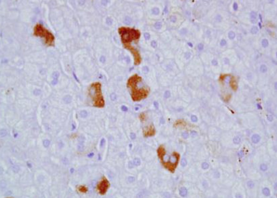 Hepatòcits esmerilats en la tinció amb HE, que es tenyeixen amb orceïna. La positivitat d'aquesta tinció és exclusiva dels hepatòcits esmerilats en portadors del VHB