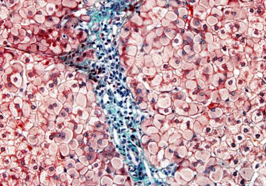Presència massiva d'hepatòcits esmerilats en la regió periportal, característica de la toxicitat per cianamida, en una tinció de tricròmic de Masson.