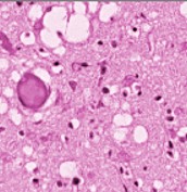 Teixit cerebral que mostra l'aspecte espongiforme de les neurones, plenes de vacúols clars