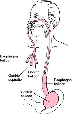 Baló de Sengstaken-Blakemore col·locat