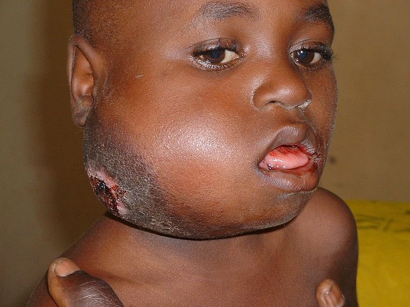Nen ugandès amb limfoma de Burkitt