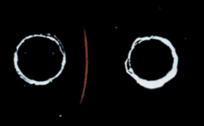 Immuno-difusió d'Ouchterlony. Línia de precipitació entre dos pouets on hi havia sang HBsAg positiva (és a dir amb Antigen Austràlia) en un i anticòs contra aquest antigen en l'altre.