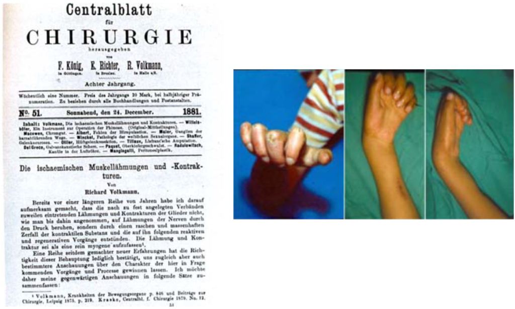 Primera pàgina de l'article de Volkmann sobre la contractura que duu el seu nom. A la dreta, una demostració del resultat de la contractura causada per un embenat massa intens.