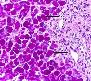 Biòpsia hepàtica tenyida amb PAS, un colorant que tenyeix el glucogen. El citoplasma de tots els hepatòcits periportals es tenyeixen intensament de vermell, indicant el seu elevat contingut en glucogen, que es disposa formant cossos d'inclusió. L' excés de glucogen en els hepatòcits pot veure's en la toxicitat per cianamida (un aversiu de l'alcohol), la malaltia de Lafora