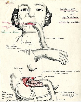 Dibuix de Mollie Lentaigne d’una intervenció d’Archibald Mc Indoe