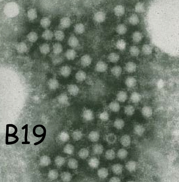 Parvovirus B19 al microscopi electrònic