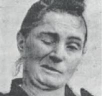 Cara d'una malalta vista per Brissaud amb espasme hemifacial