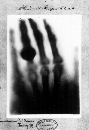 Primera radiografia mèdica de Wilhelm Röntgen de la mà de la seva dona Anna Bertha Ludwig