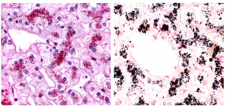 Pigment de Dubin-Johnson en el citoplasma dels hepatòcits de la regió centrelobular, que no presenten altres lesions. A l'esquerra, tinció d'HE, i a la dreta tinció de Fontana-Masson, que tenyeix de negre la melanina i pigments afins. Pres de M.Bruguera Cortada, Annals de Medicina, 2020; 103: 174-177.