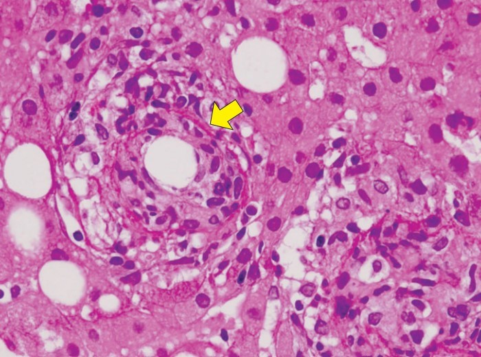 Granuloma tipus donut, constituït per un agregat de macròfags i limfòcits que envolten un vacúol clar central i presència d'un anell fi de fibrina (fletxa), que tradueix necrosi fibrinoide de la paret sinusoïdal, típica de la febre Q. (Presa de l'article Granulomas hepáticos. Miquel Bruguera i Rosa Miquel. Gastroent. continuada, 2009)