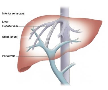 TIPS situat entre una branca intrahepàtica de la vena porta i una rama de la vena hepàtica