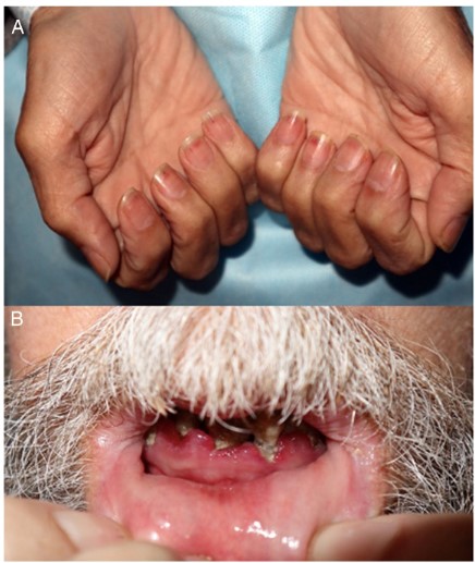 A.Hemorràgies a les ungles de les mans
B.Gingivitis hemorràgica, hipertròfia gingival i pèrdua dentària