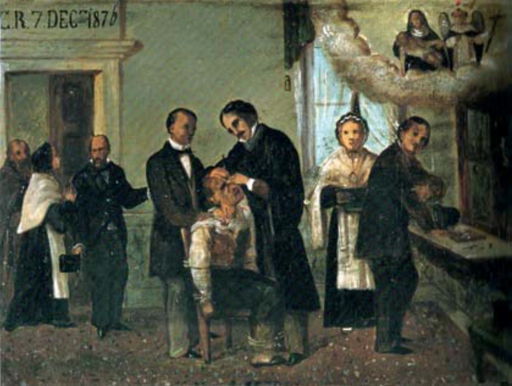 Intervenció de cataractes en aquest exvot del 1876, del santuari de Sant Domenico a Chioggia (Venezia).