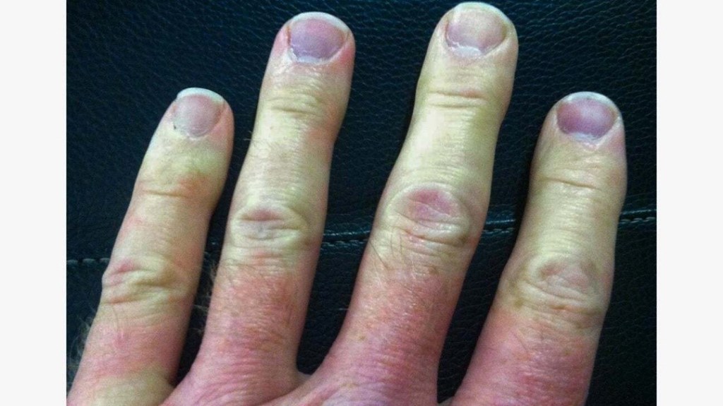 Esclerodactília en una malalta amb cirrosi biliar primària