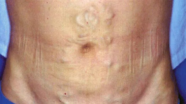 Circulació venosa periumbilical