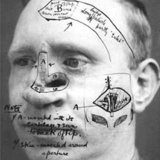 Dibuix de Gillies de les diferents intervencions que hauria de fer en rostre d'un militar que havia d'operar.