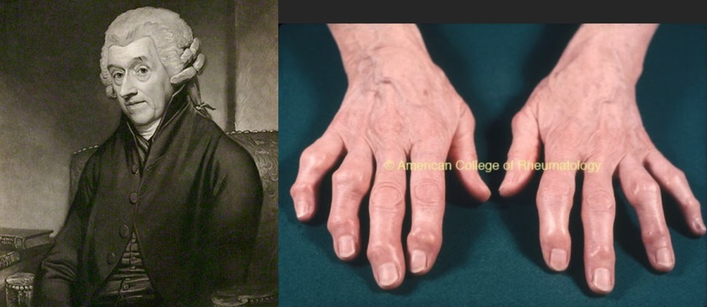 William Heberden i els nòduls que va descriure