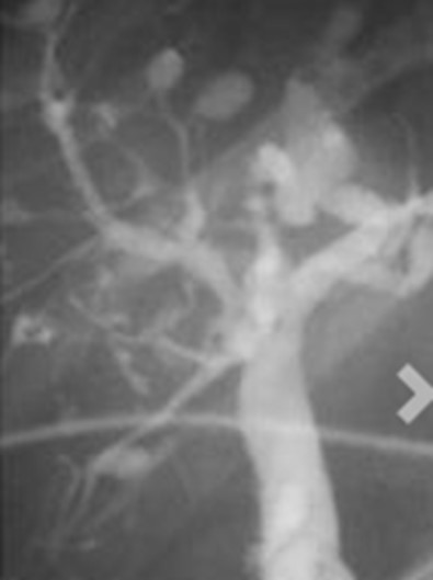 Colangiografia que mostra dilatacions saculars de la via biliar intra-hepàtica