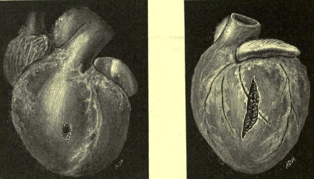 Lesió per arma blanca del miocardi