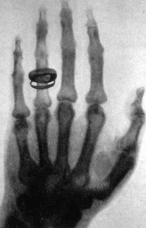 Radiografia de Wilhelm Röntgen de la mà d'Albert von Kölliker